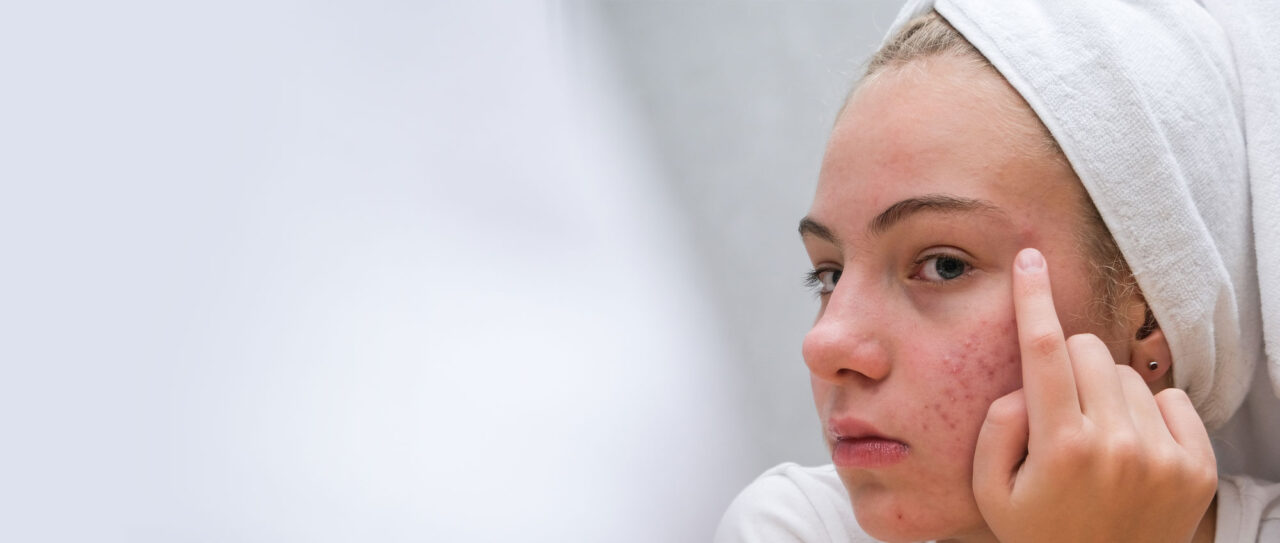 Advanced Acne Treatment